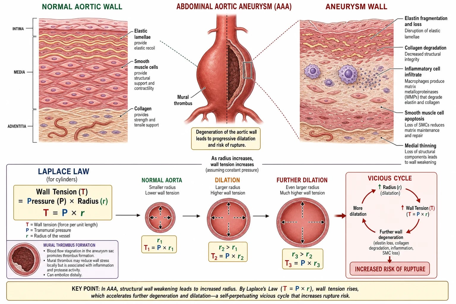 Cross-section of aneurysm wall showing elastin and collagen degradation, MMP activity, mural thrombus, and the Laplace law equation.