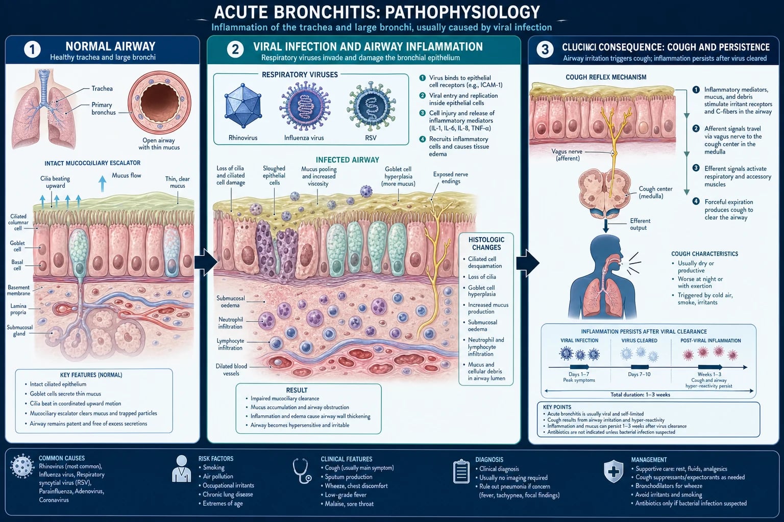 Medical pathophysiology infographic of acute bronchitis mechanism: normal ciliated epithelium, viral invasion with epithelial desquamation and ciliary loss, neutrophilic inflammation and mucus pooling, and persistent cough from airway hyper-reactivity