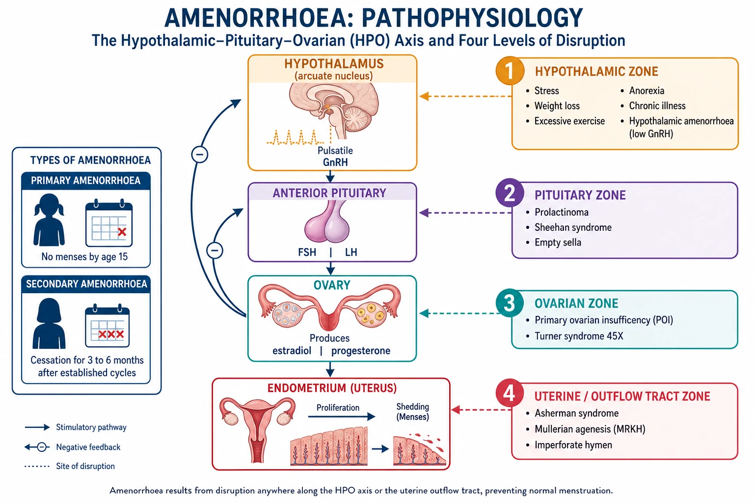 Pathophysiology infographic of the hypothalamic-pituitary-ovarian axis with four colour-coded interruption zones and feedback loops