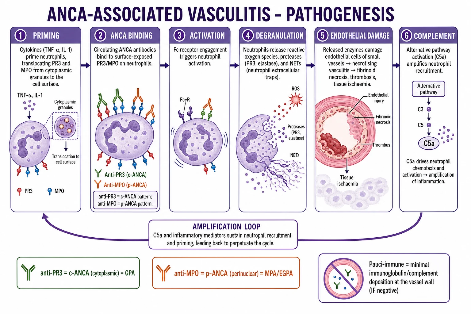 Clean infographic: ANCA neutrophil activation, NETosis, alternative complement pathway