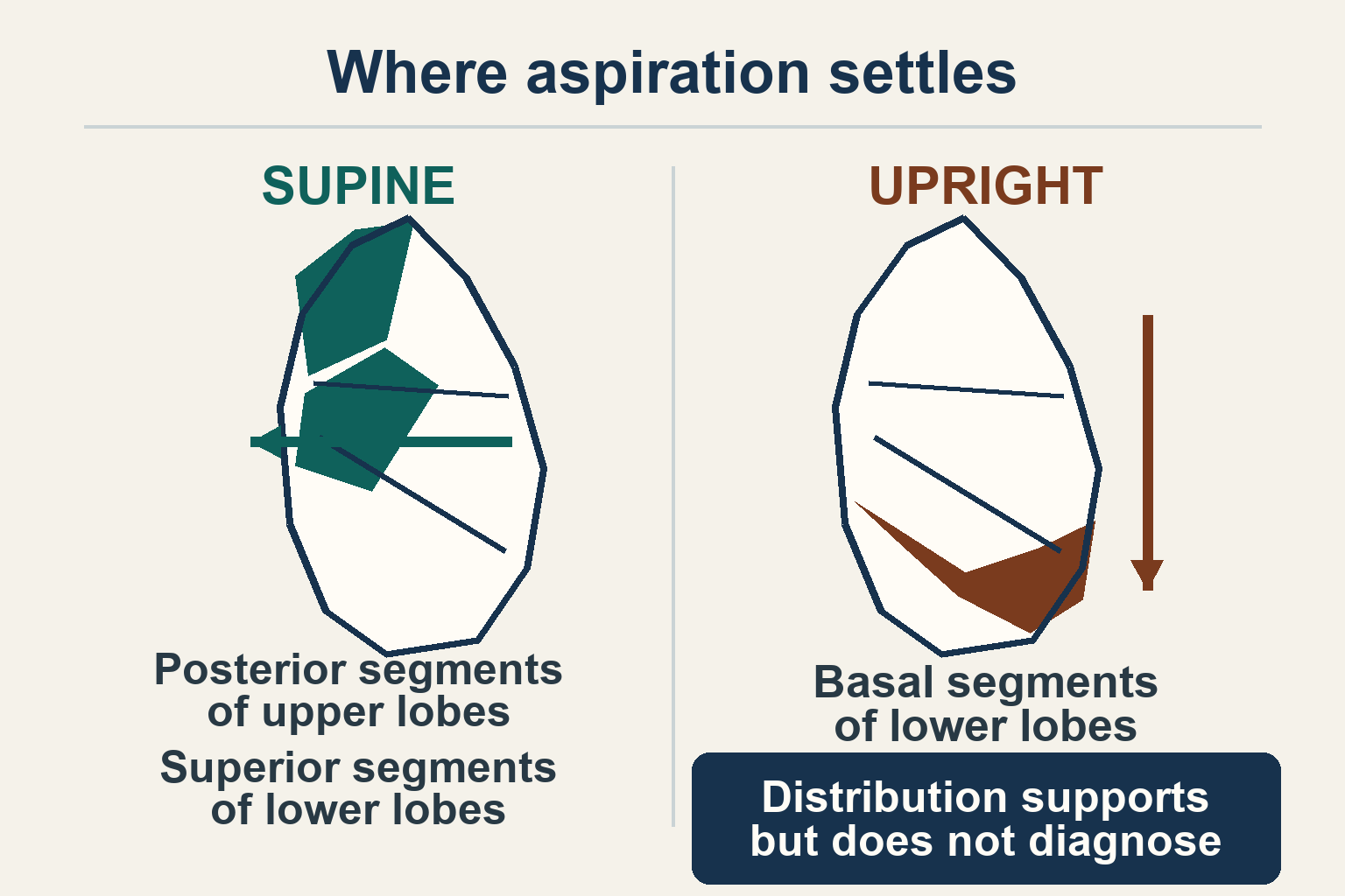 Lung diagram marking posterior upper-lobe and superior lower-lobe segments in a supine patient and basal lower-lobe segments in an upright patient, with a warning that distribution supports but does not diagnose aspiration
