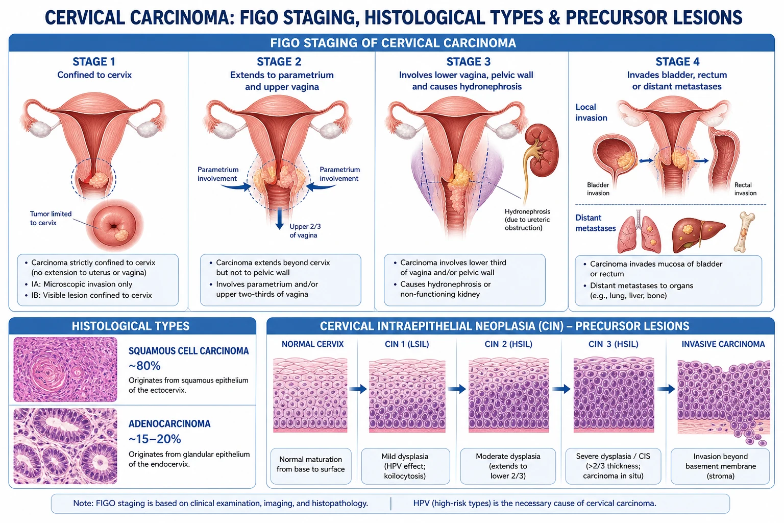 CIN classification and FIGO 2018 staging of cervical cancer.