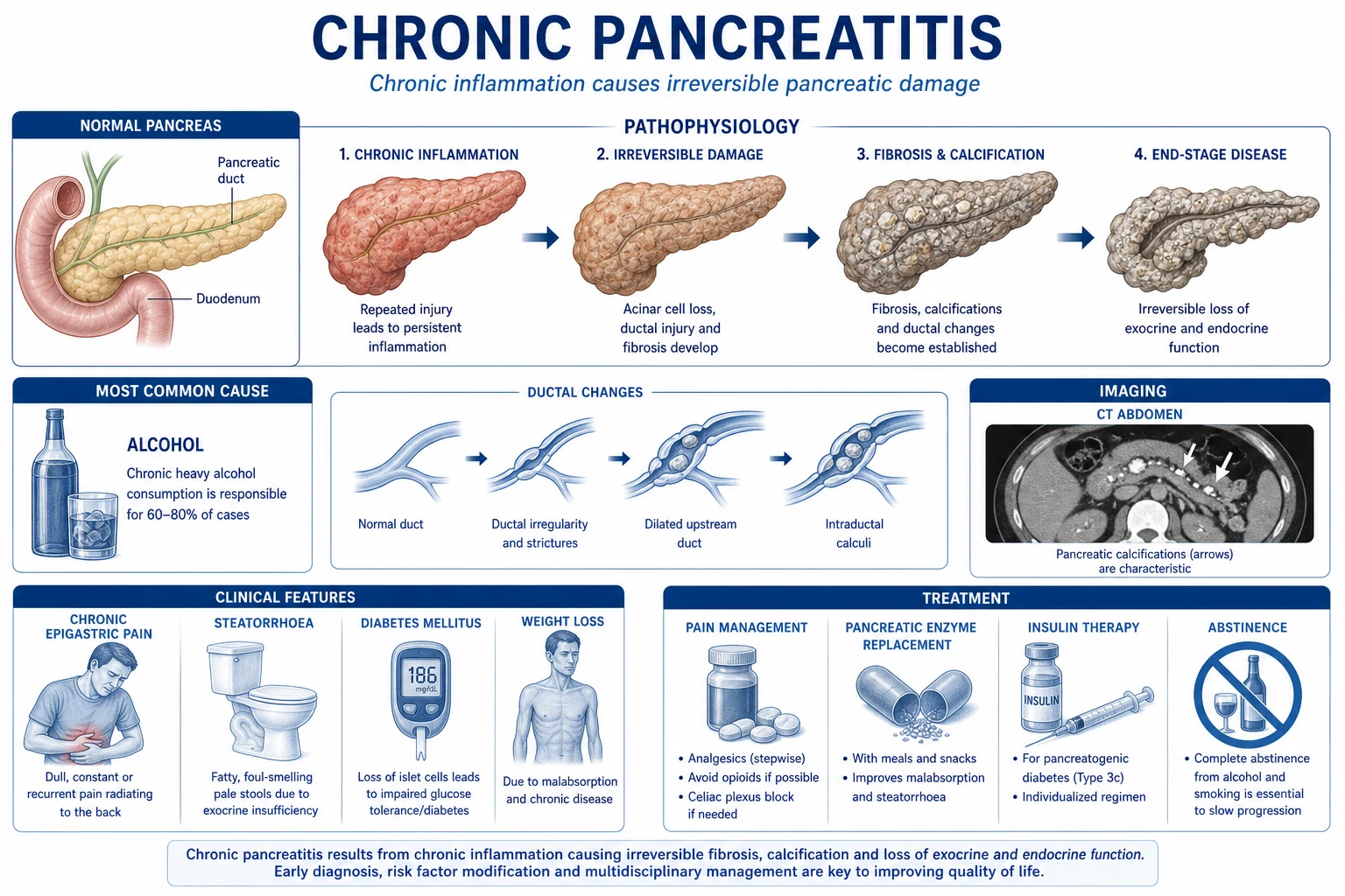 Mechanism infographic: pancreatic stellate cell activation by alcohol/cytokines, collagen fibrosis, intraductal calcific stones, ductal hypertension, perineural inflammation, exocrine and endocrine loss