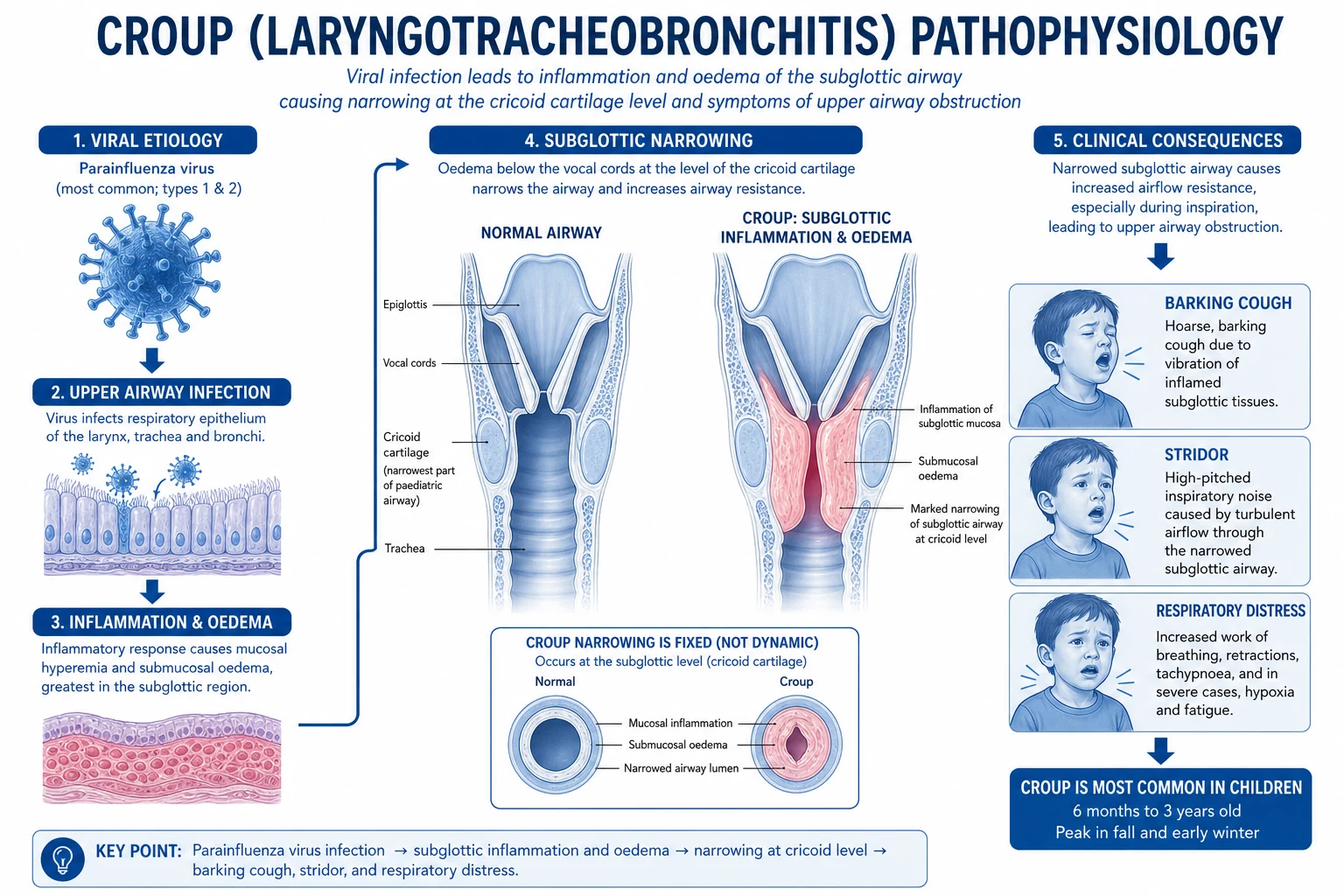 Anatomy of paediatric subglottis showing cricoid complete cartilaginous ring with inward mucosal oedema, narrowed lumen, Poiseuille relationship between radius and resistance, and turbulent inspiratory airflow generating stridor