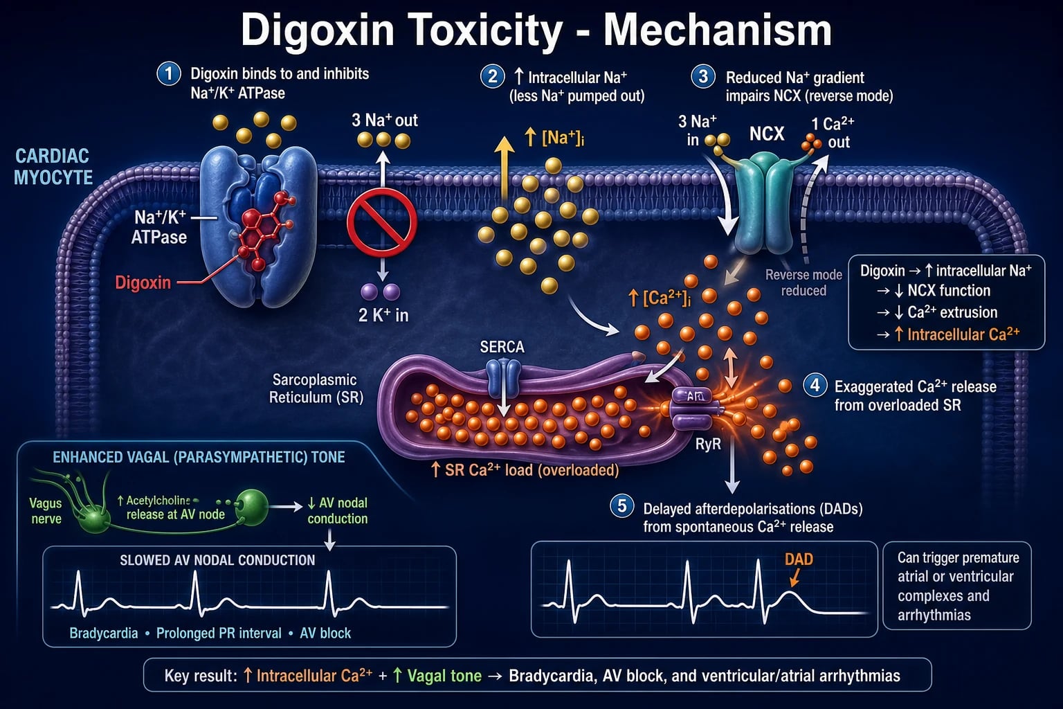 Medical educational figure of the molecular pathophysiology of digoxin toxicity inside a cardiac myocyte: Na+/K+ ATPase blocked by digoxin, rising intracellular Na+ and Ca2+, NCX reduced, sarcoplasmic reticulum overload producing delayed afterdepolarisations on an ECG trace, and vagal slowing of the AV node