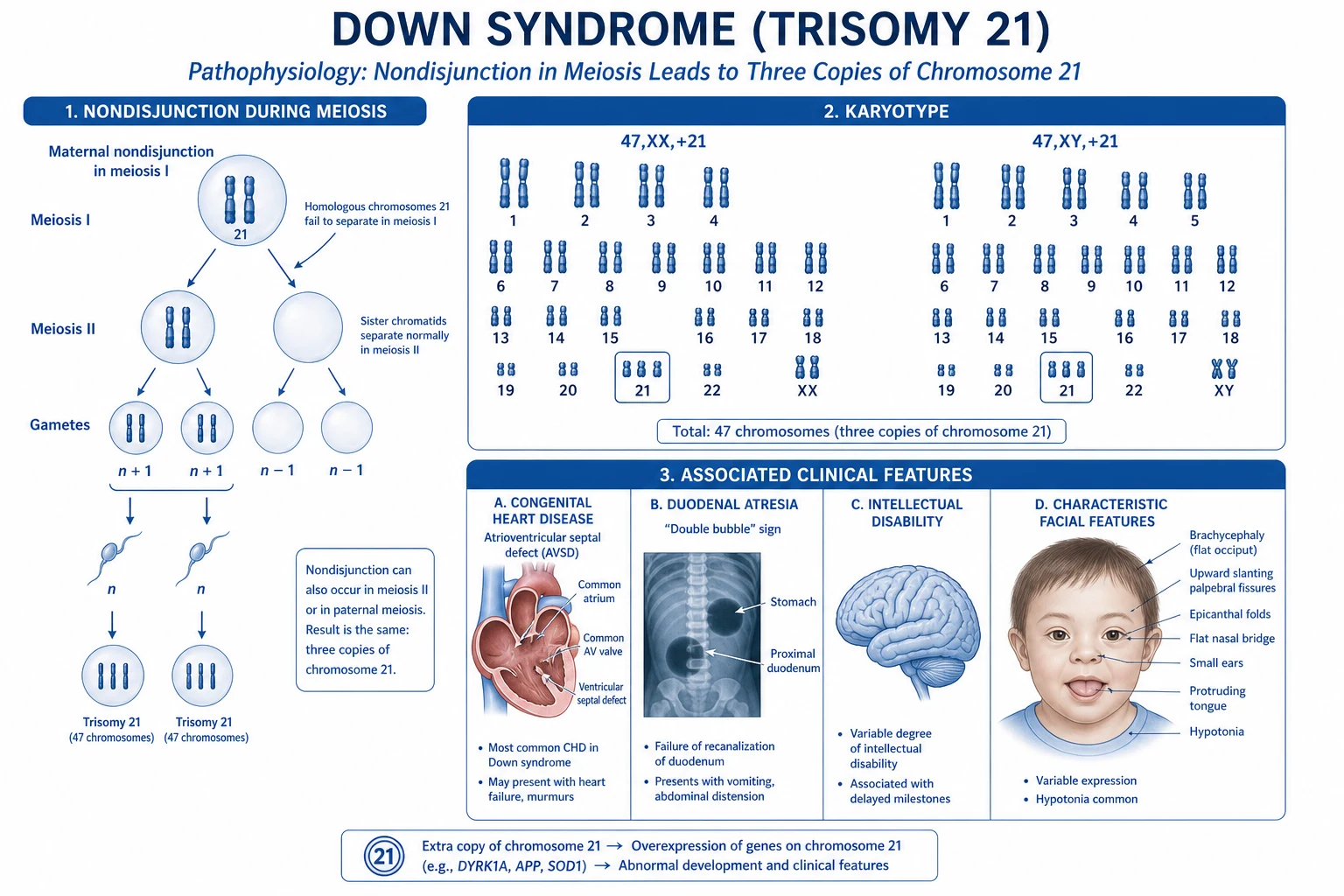 Diagram of the molecular pathophysiology of Down syndrome: the Down syndrome critical region on chromosome 21q22, key candidate genes (DYRK1A, APP, RCAN1, SOD1, CBS, ERG, ETS2), and how their overexpression drives the cardiac, neural, haematological, and endocrine phenotypes