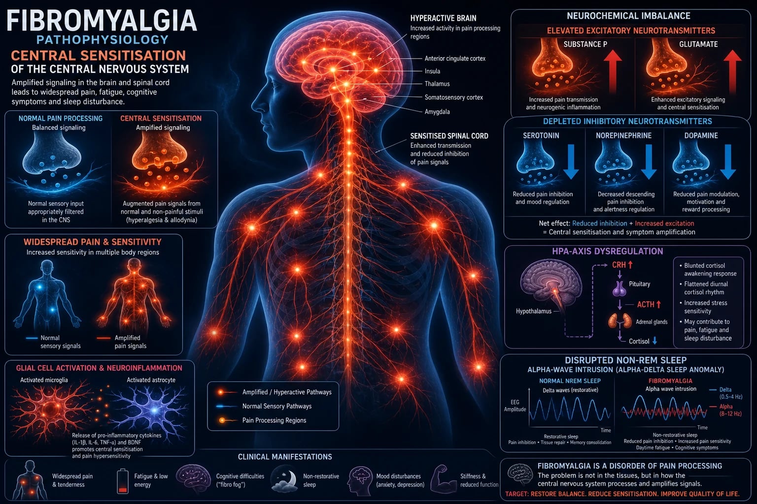 Cinematic medical illustration of fibromyalgia pathophysiology: central sensitisation of the CNS with a glowing brain and spinal cord, amplified orange-red nerve pathways to widespread body regions, neurotransmitter imbalance arrows, and alpha-delta sleep anomaly