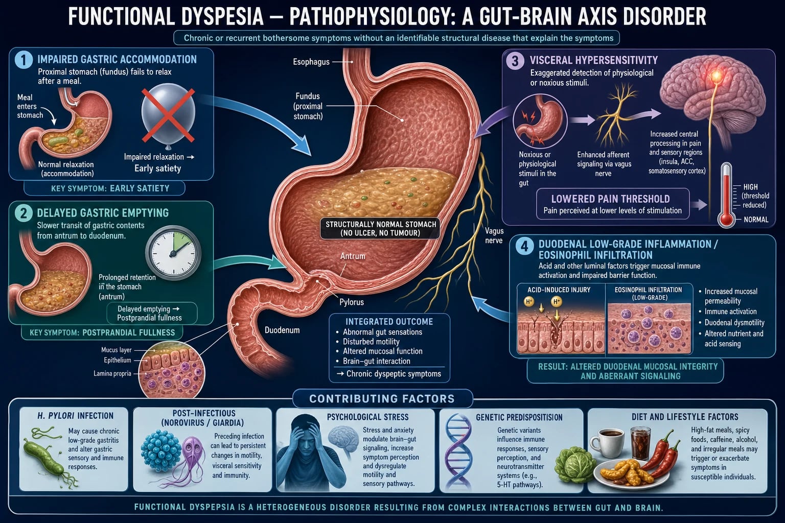 Medical educational infographic of functional dyspepsia pathophysiology as a gut-brain axis disorder with four converging mechanisms