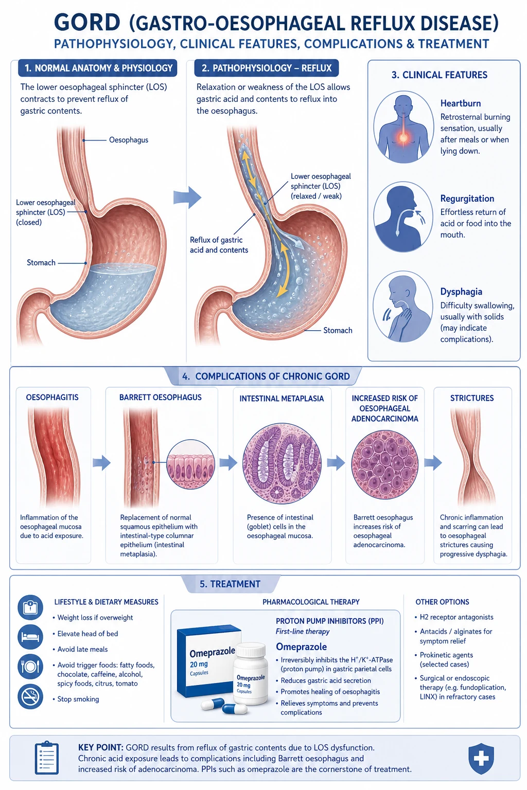 Mechanism infographic of the gastro-oesophageal junction showing the five pathophysiological mechanisms: transient LES relaxations, weak/hypotensive LES, sliding hiatus hernia disrupting the crural diaphragm, impaired peristaltic clearance, and delayed gastric emptying, leading to acid-peptic-bile injury and the metaplasia-dysplasia-adenocarcinoma sequence