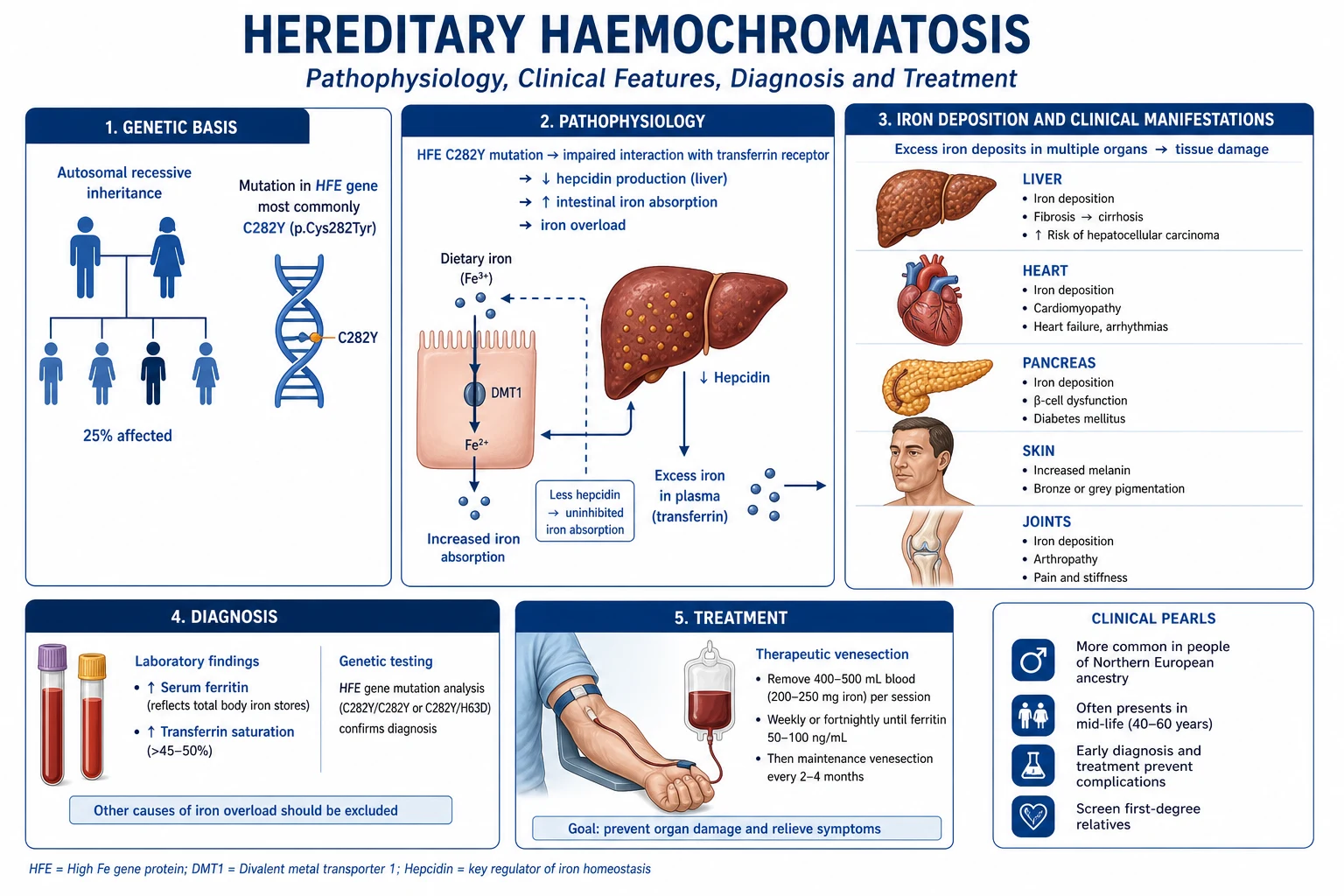 Pathophysiology infographic of the hepcidin–ferroportin axis in HFE haemochromatosis showing unregulated iron absorption, Fenton-chemistry oxidative injury and parenchymal deposition