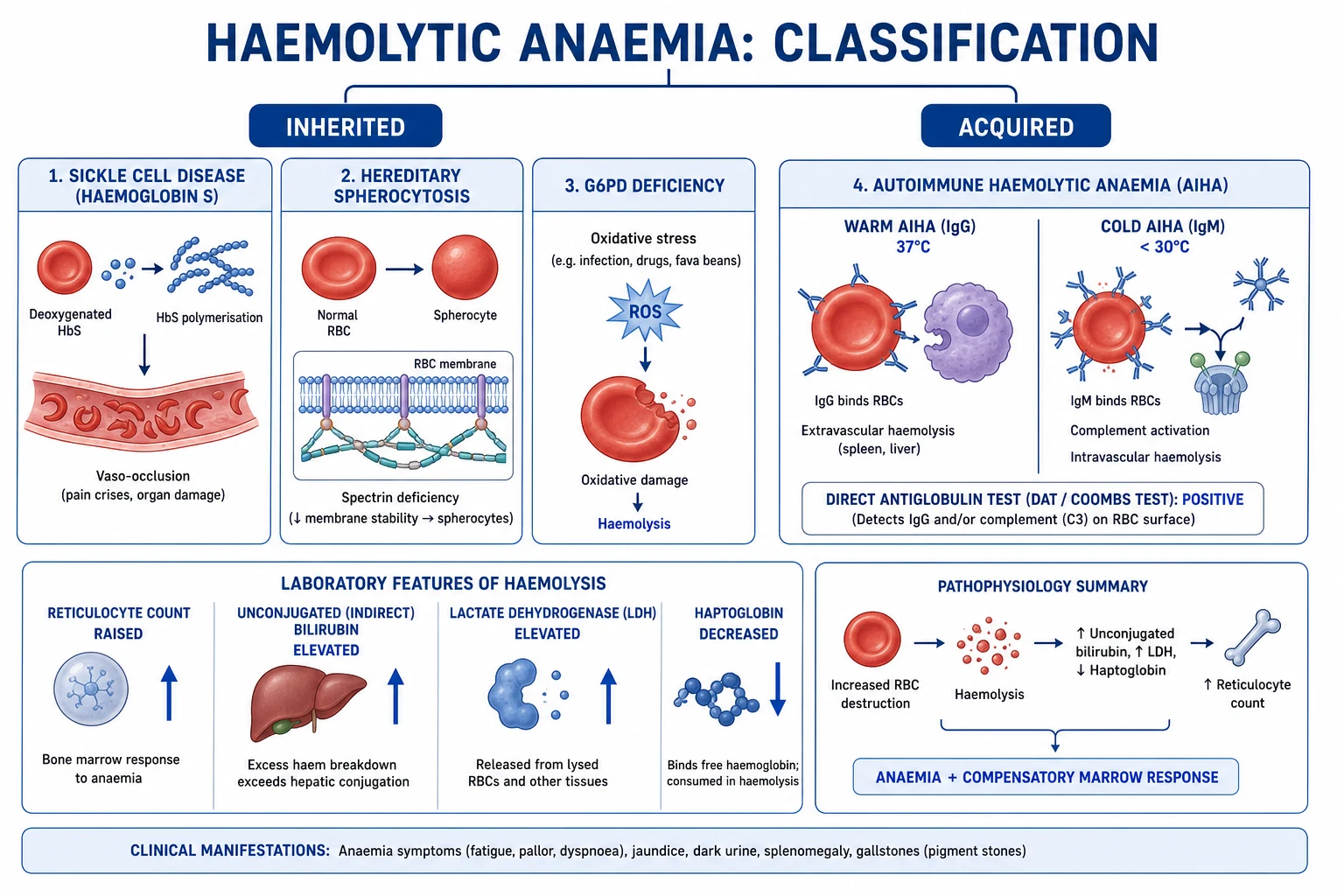 Detailed medical pathophysiology infographic showing the two destruction sites in parallel — extravascular splenic macrophage pathway on the left, intravascular free-haemoglobin pathway on the right — converging on the shared biochemical signature of raised reticulocytes, LDH, unconjugated bilirubin and low haptoglobin