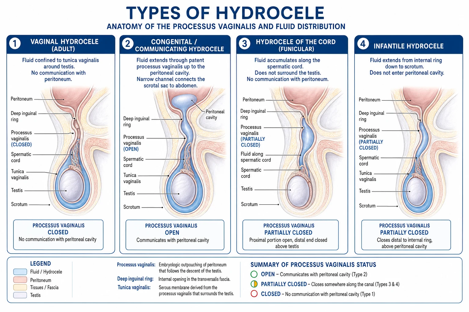 Four schematic diagrams of the anatomical types of hydrocele — vaginal, congenital/communicating, infantile, and hydrocele of the cord — shown in relation to the inguinal canal and peritoneum.