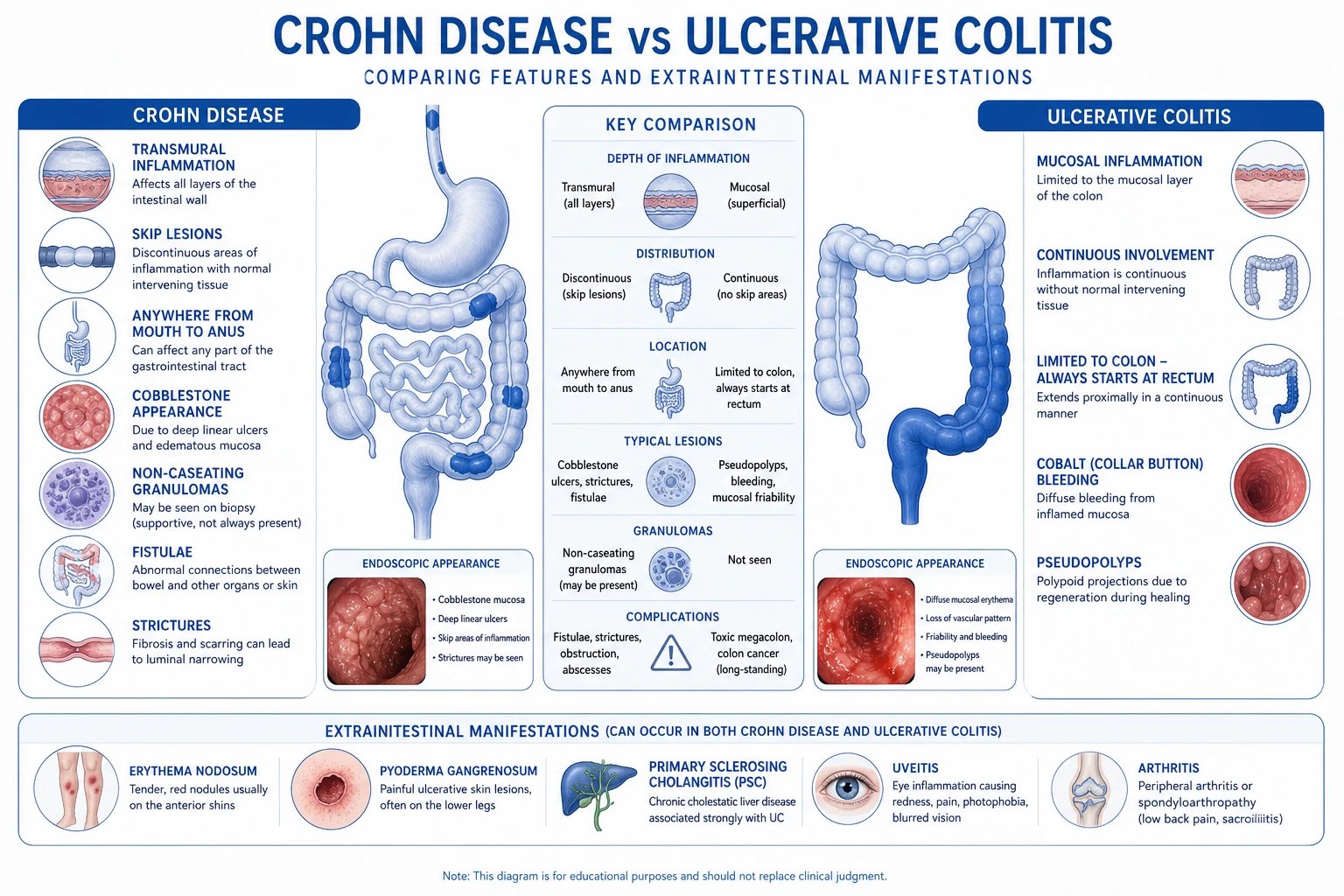 Inflammatory Bowel Disease pathophysiology educational diagram