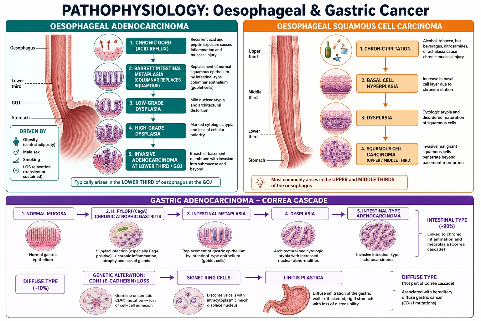 Mechanism infographic showing the Barrett's metaplasia-dysplasia-adenocarcinoma cascade, squamous carcinoma from chronic injury, and the Correa cascade for gastric intestinal-type adenocarcinoma with diffuse CDH1 signet-ring pathway