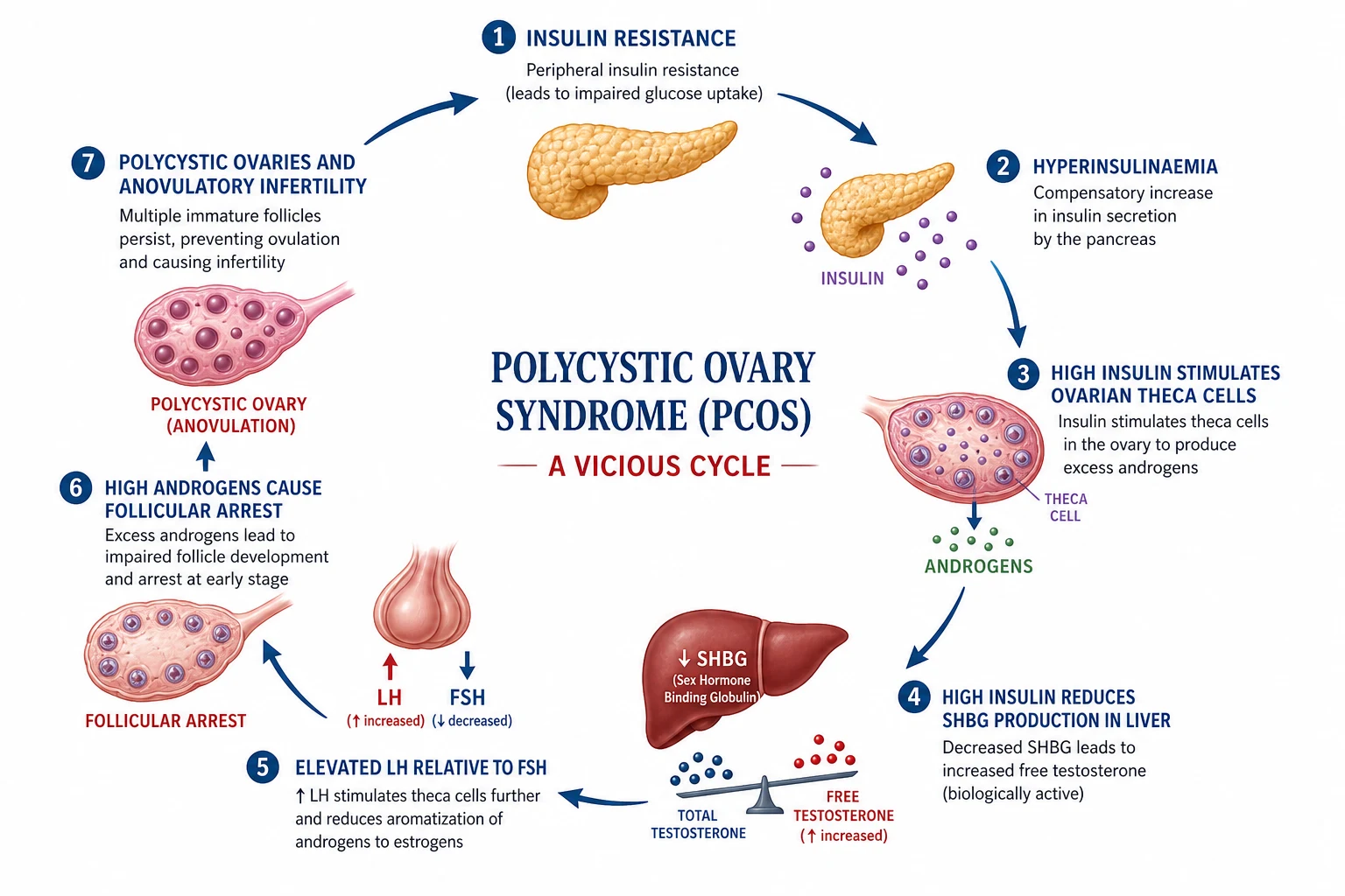 PCOS vicious cycle: insulin resistance to hyperandrogenism to anovulation.