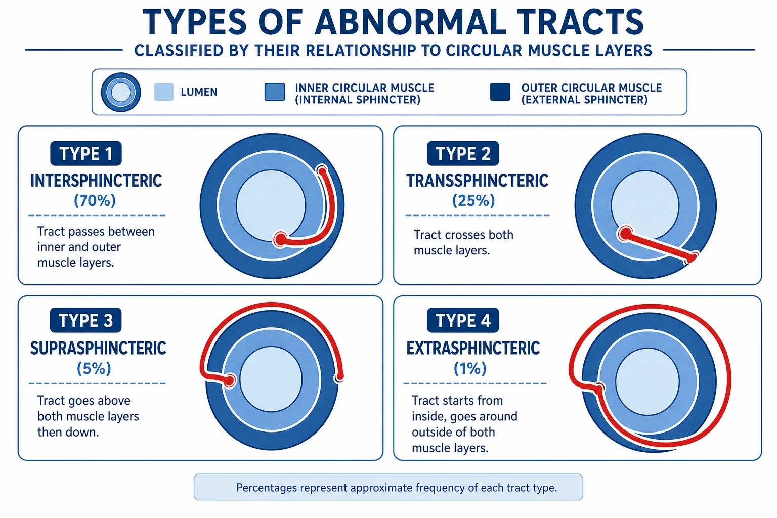 Park's classification of anal fistulas showing intersphincteric, transsphincteric, suprasphincteric, and extrasphincteric types.