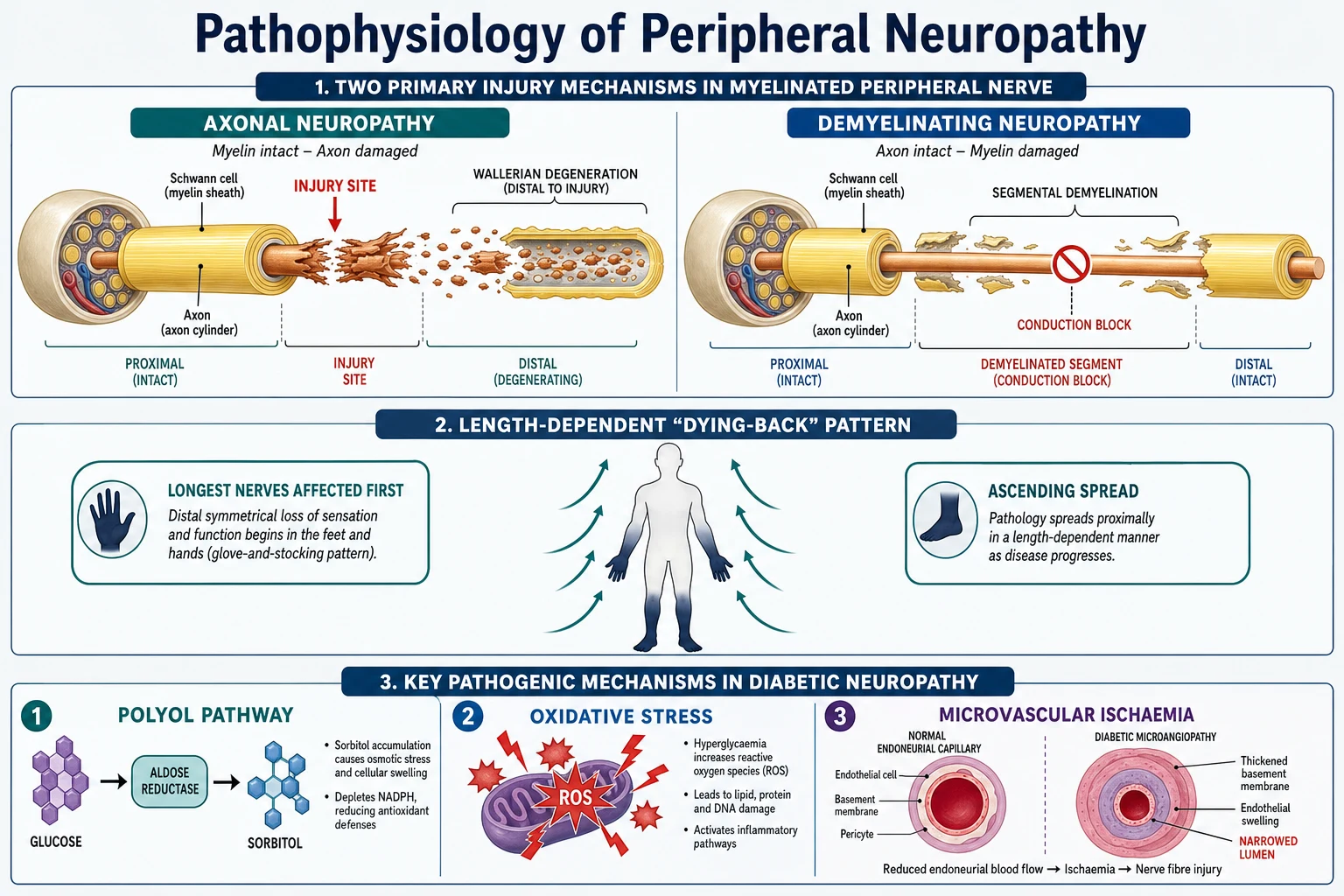 Labelled medical infographic showing axonal versus demyelinating nerve injury, a glove-and-stocking length-dependent body silhouette with proximal-spread arrows, and three diabetic-mechanism panels (polyol pathway, oxidative stress, microvascular ischaemia)