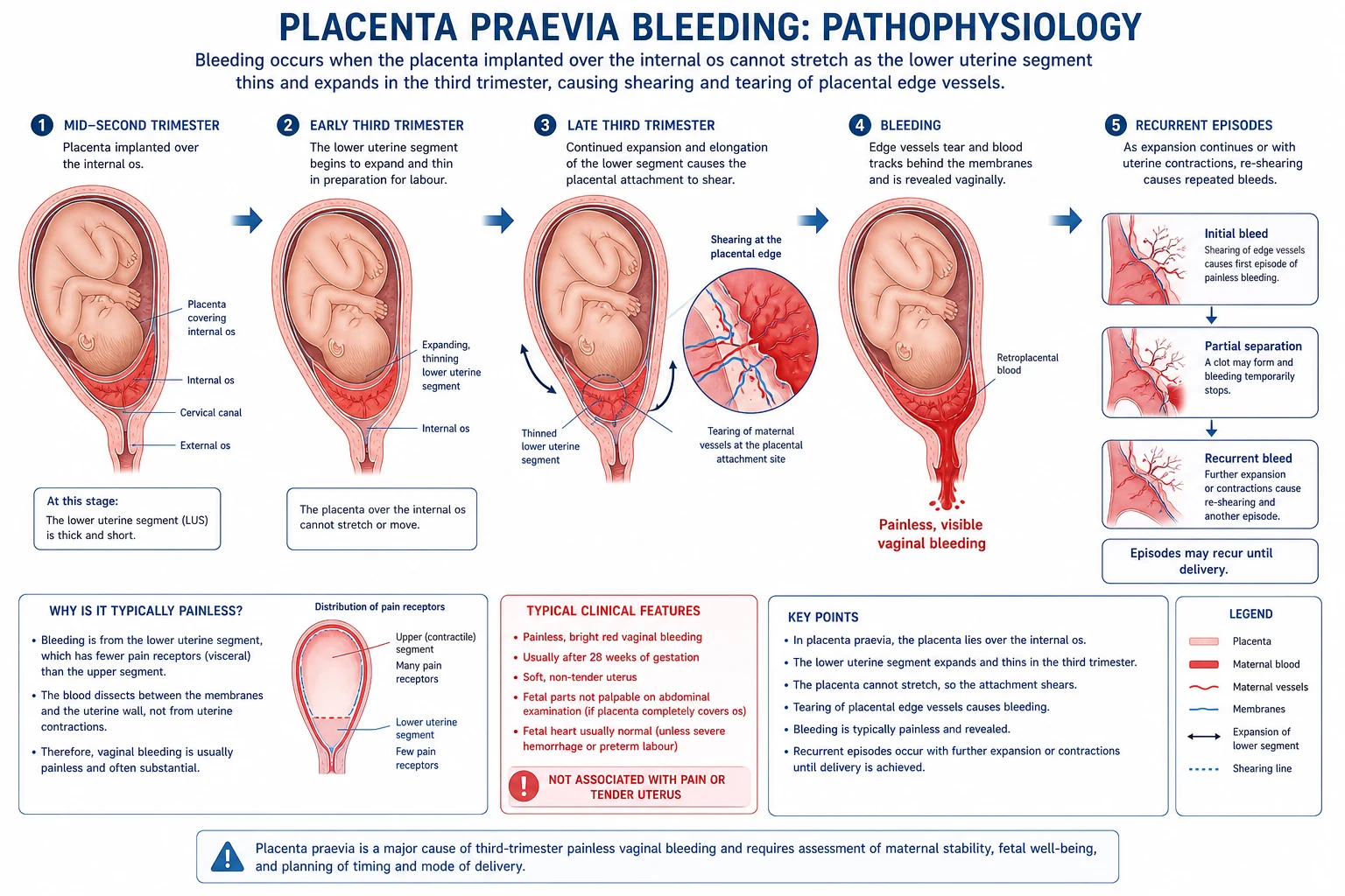Pathophysiology: lower-segment expansion shearing the placental edge.