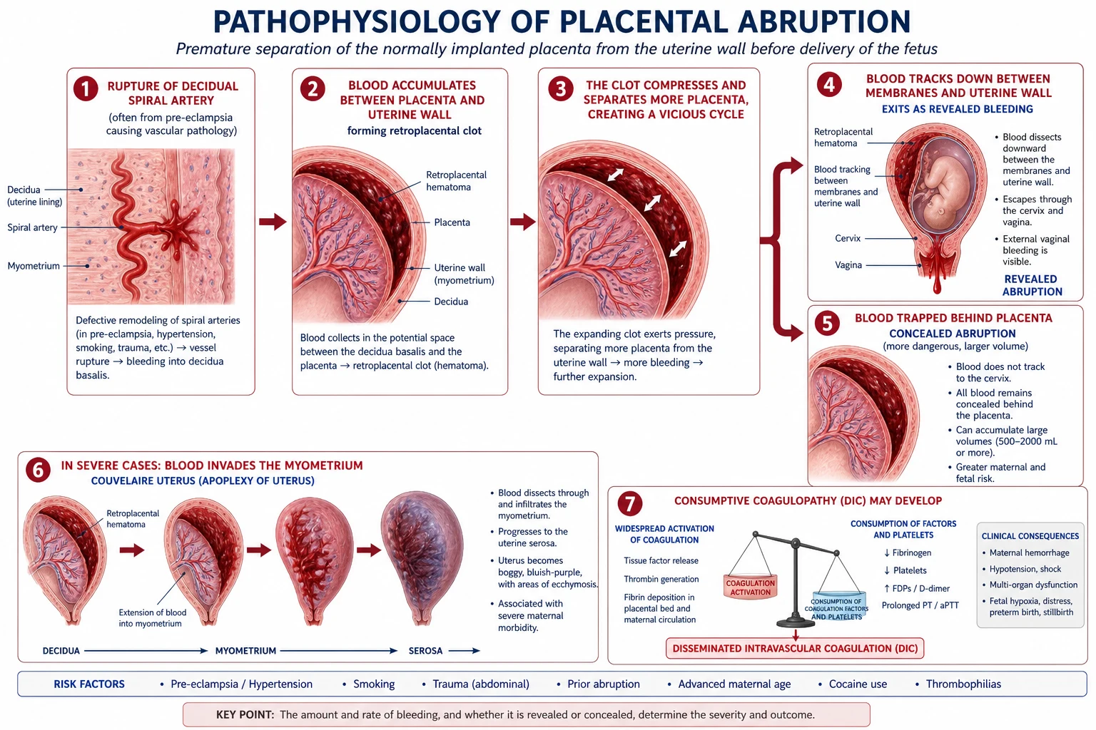 Pathophysiological cascade of placental abruption from spiral artery rupture to Couvelaire uterus and DIC.