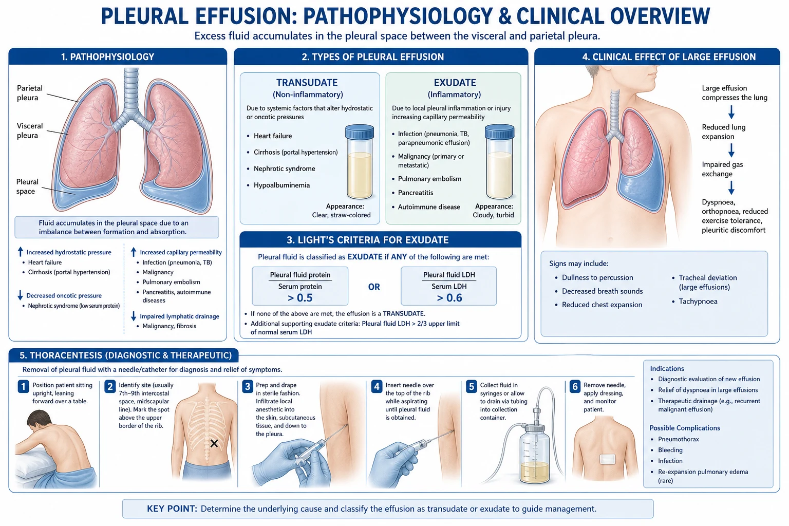 Four-mechanism infographic of pleural fluid accumulation with Starling forces and lymphatic drainage