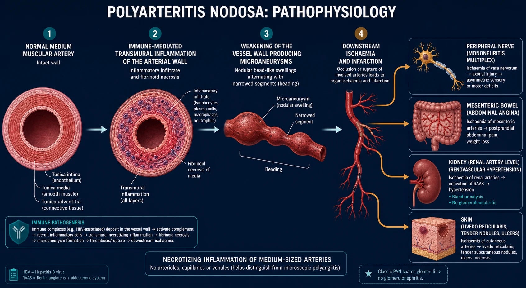 Horizontal left-to-right pathophysiology pathway of polyarteritis nodosa on a deep navy background, showing a normal medium muscular artery progressing to transmural inflammation and fibrinoid necrosis, then microaneurysm and beading formation, then downstream ischaemia branching to nerve, gut, kidney and skin