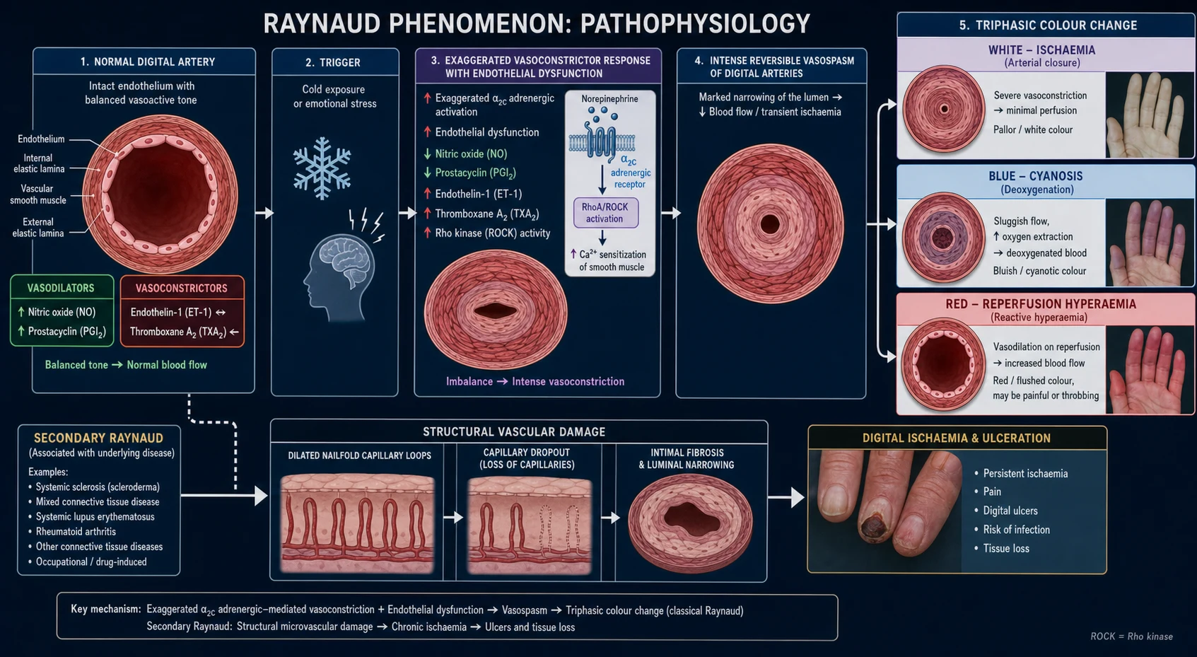 Horizontal left-to-right pathophysiology pathway of Raynaud phenomenon on a deep navy background: normal digital artery with balanced vasodilator (NO, prostacyclin) and vasoconstrictor (endothelin-1, thromboxane) tone, then cold/stress trigger, then exaggerated alpha-2C adrenergic response with endothelial dysfunction causing intense reversible vasospasm, then the triphasic colour change branching white ischaemia, blue cyanosis, red reperfusion, with a side branch showing secondary Raynaud structural damage with dilated nailfold capillary loops, dropout and digital ulcers
