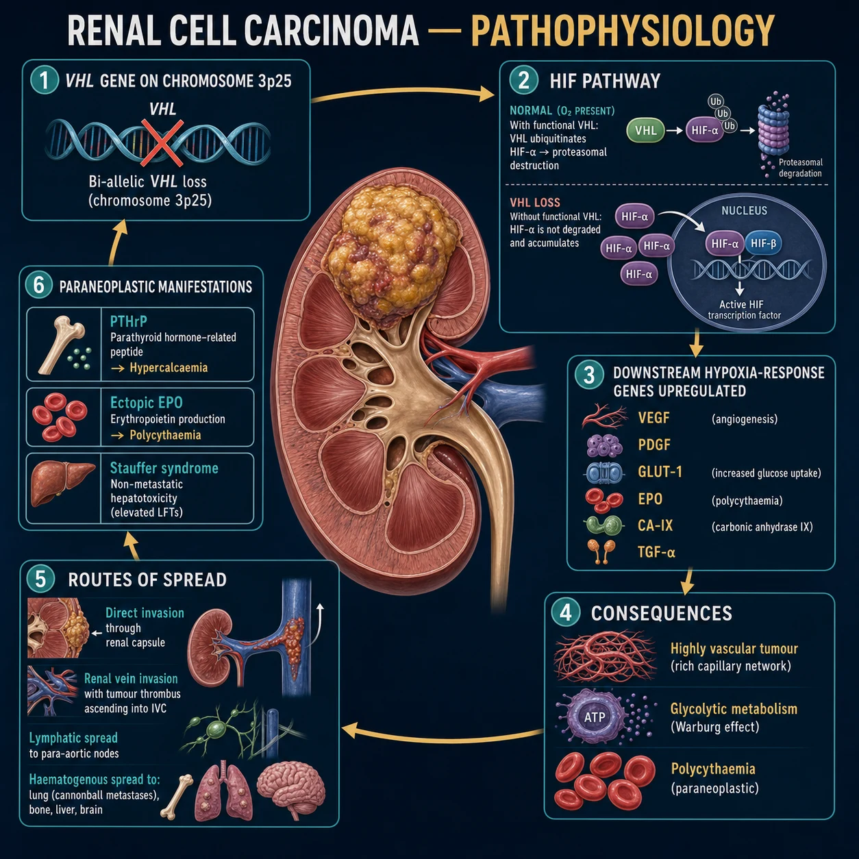 Mechanism infographic of clear-cell RCC: VHL gene on chromosome 3p25, bi-allelic loss, HIF-alpha accumulation, hypoxia-response gene cassette (VEGF, PDGF, EPO, GLUT-1, CA-IX), paraneoplastic syndromes, and routes of spread including renal vein and IVC tumour thrombus