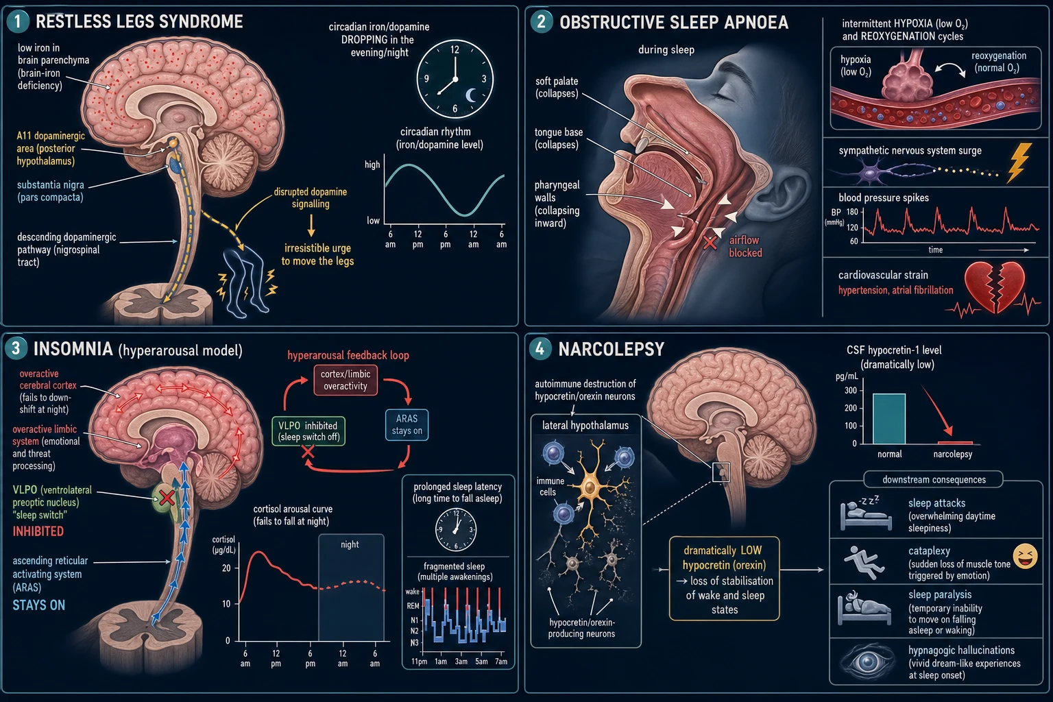 Labelled four-panel pathophysiology infographic: RLS brain-iron deficiency and A11 dopaminergic dysregulation; OSA upper-airway collapse with intermittent hypoxia; insomnia VLPO sleep-switch failure; narcolepsy autoimmune hypocretin-neuron loss